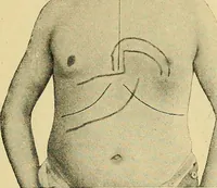 An illustration from Lehrbuch der Krankheiten des Herzens und der Blutgefässe (1906)