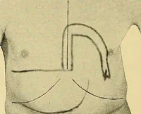 An illustration from Lehrbuch der Krankheiten des Herzens und der Blutgefässe (1906)