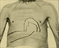 An illustration from Lehrbuch der Krankheiten des Herzens und der Blutgefässe (1906)