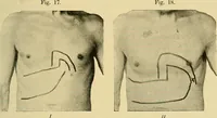 An illustration from Lehrbuch der Krankheiten des Herzens und der Blutgefässe (1906)