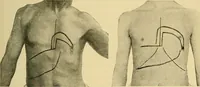 An illustration from Lehrbuch der Krankheiten des Herzens und der Blutgefässe (1906)