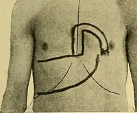 Picture 13 of 34 from Lehrbuch der Krankheiten des Herzens und der Blutgefässe (1906), leaf 198