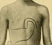 An illustration from Lehrbuch der Krankheiten des Herzens und der Blutgefässe (1906)