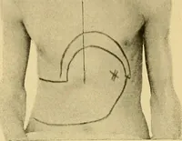 Picture 17 of 34 from Lehrbuch der Krankheiten des Herzens und der Blutgefässe (1906), leaf 210