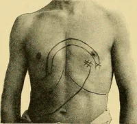 Picture 21 of 34 from Lehrbuch der Krankheiten des Herzens und der Blutgefässe (1906), leaf 221
