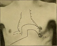 An illustration from Lehrbuch der Krankheiten des Herzens und der Blutgefässe (1906)