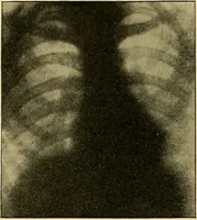 Picture 3 of 34 from Lehrbuch der Krankheiten des Herzens und der Blutgefässe (1906), leaf 37