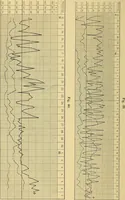 An illustration from Lehrbuch der Krankheiten des Herzens und der Blutgefässe (1906)
