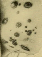 An illustration from Lehrbuch der Krankheiten des Herzens und der Blutgefässe (1906)