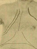 An illustration from Lehrbuch der Krankheiten des Herzens und der Blutgefässe (1906)