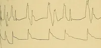 Picture 6 of 34 from Lehrbuch der Krankheiten des Herzens und der Blutgefässe (1906), leaf 64
