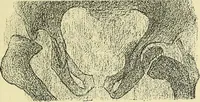 An illustration from Leçons cliniques de chirurgie infantile : deuxième série (1905)