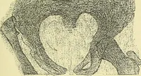 Picture 22 of 62 from Leçons cliniques de chirurgie infantile : deuxième série (1905), leaf 204