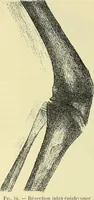 An illustration from Leçons cliniques de chirurgie infantile : deuxième série (1905)