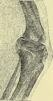 An illustration from Leçons cliniques de chirurgie infantile : deuxième série (1905)