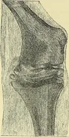 Picture 28 of 62 from Leçons cliniques de chirurgie infantile : deuxième série (1905), leaf 223