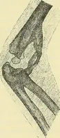 Picture 30 of 62 from Leçons cliniques de chirurgie infantile : deuxième série (1905), leaf 247