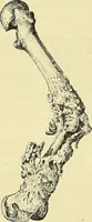 An illustration from Leçons cliniques de chirurgie infantile : deuxième série (1905)