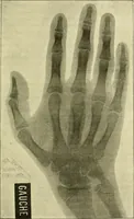 Picture 33 of 62 from Leçons cliniques de chirurgie infantile : deuxième série (1905), leaf 306