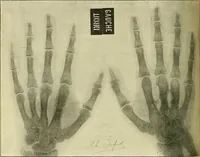 Picture 34 of 62 from Leçons cliniques de chirurgie infantile : deuxième série (1905), leaf 309