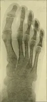 An illustration from Leçons cliniques de chirurgie infantile : deuxième série (1905)