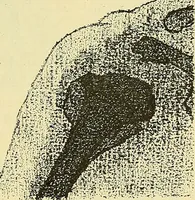 An illustration from Leçons cliniques de chirurgie infantile : deuxième série (1905)