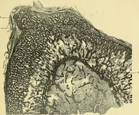 An illustration from Leçons cliniques de chirurgie infantile : deuxième série (1905)