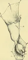 Picture 43 of 62 from Leçons cliniques de chirurgie infantile : deuxième série (1905), leaf 394