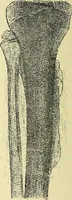 An illustration from Leçons cliniques de chirurgie infantile : deuxième série (1905)