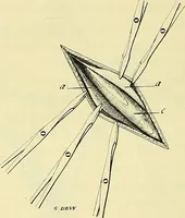Picture 48 of 62 from Leçons cliniques de chirurgie infantile : deuxième série (1905), leaf 449