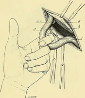 Picture 49 of 62 from Leçons cliniques de chirurgie infantile : deuxième série (1905), leaf 450