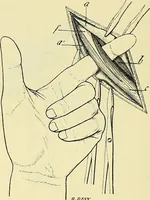 An illustration from Leçons cliniques de chirurgie infantile : deuxième série (1905)