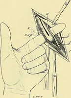 An illustration from Leçons cliniques de chirurgie infantile : deuxième série (1905)