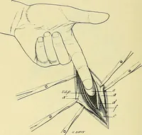 Picture 52 of 62 from Leçons cliniques de chirurgie infantile : deuxième série (1905), leaf 453