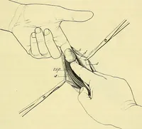 An illustration from Leçons cliniques de chirurgie infantile : deuxième série (1905)