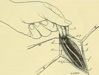 Picture 54 of 62 from Leçons cliniques de chirurgie infantile : deuxième série (1905), leaf 456