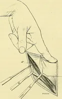 An illustration from Leçons cliniques de chirurgie infantile : deuxième série (1905)