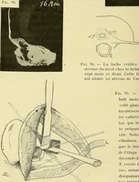 Picture 58 of 62 from Leçons cliniques de chirurgie infantile : deuxième série (1905), leaf 565