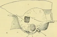 An illustration from Leçons cliniques de chirurgie infantile : deuxième série (1905)