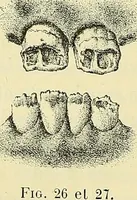 Picture 13 of 62 from Leçons cliniques de chirurgie infantile : deuxième série (1905), leaf 59