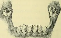 An illustration from Leçons cliniques de chirurgie infantile : deuxième série (1905)