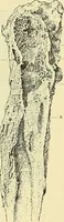 An illustration from Leçons cliniques de chirurgie infantile : deuxième série (1905)