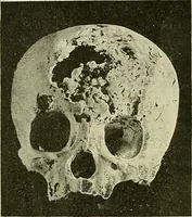 An illustration from Leçons cliniques de chirurgie infantile : deuxième série (1905)