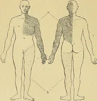 An illustration from Leçons cliniques sur l'hystérie et l'hypnotisme : faites à l'Hôpital Saint-André de Bordeaux (1891)