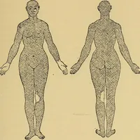 An illustration from Leçons cliniques sur l'hystérie et l'hypnotisme : faites à l'Hôpital Saint-André de Bordeaux (1891)