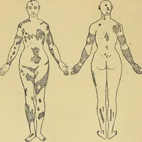An illustration from Leçons cliniques sur l'hystérie et l'hypnotisme : faites à l'Hôpital Saint-André de Bordeaux (1891)