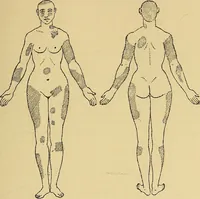 An illustration from Leçons cliniques sur l'hystérie et l'hypnotisme : faites à l'Hôpital Saint-André de Bordeaux (1891)