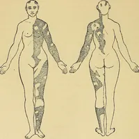 Picture 14 of 85 from Leçons cliniques sur l'hystérie et l'hypnotisme : faites à l'Hôpital Saint-André de Bordeaux (1891), leaf 155