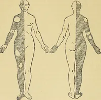 Picture 15 of 85 from Leçons cliniques sur l'hystérie et l'hypnotisme : faites à l'Hôpital Saint-André de Bordeaux (1891), leaf 203