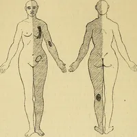 An illustration from Leçons cliniques sur l'hystérie et l'hypnotisme : faites à l'Hôpital Saint-André de Bordeaux (1891)